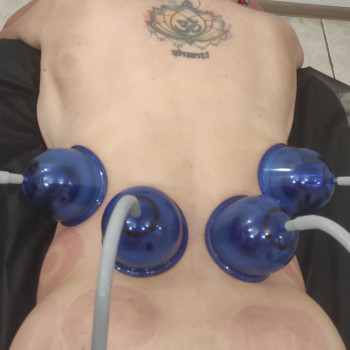 Помпаж вакуумом