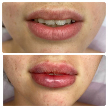 Увеличение губ
                    Косметолог Дарья Мариуполь