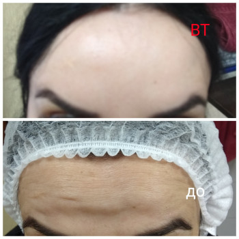 Ботулотоксин