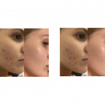 Гигиеническая чистка лица
                    Косметолог Мирослава Харьков