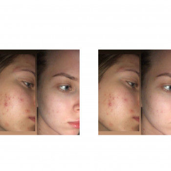 Гигиеническая чистка лица
                    Косметолог Мирослава Харьков