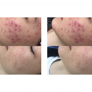 Гигиеническая чистка лица
                    Косметолог Мирослава Харьков