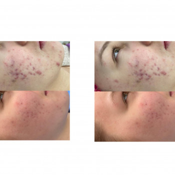 Гигиеническая чистка лица
                    Косметолог Мирослава Харьков