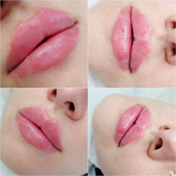 Контурная пластика губ