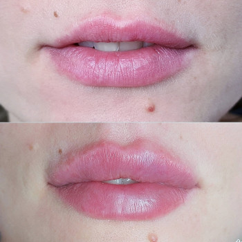 Контурная пластика губ