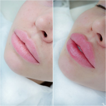 Контурная пластика губ
