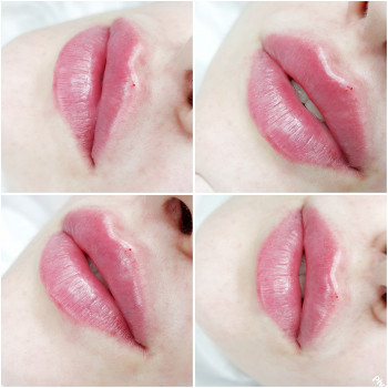 Контурная пластика губ