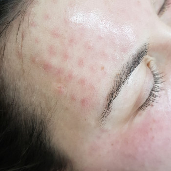 Биоревитализация
                    Косметолог-инъекционист Алина Днепр