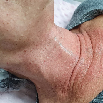 Биоревитализация
                    Косметолог-инъекционист Алина Днепр