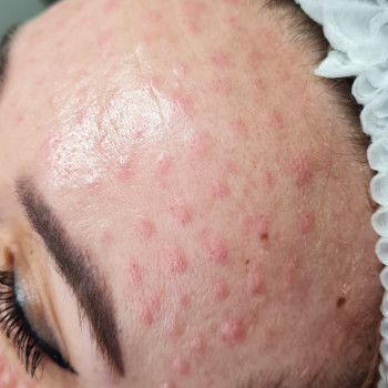 Биоревитализация
                    Косметолог-инъекционист Алина Днепр