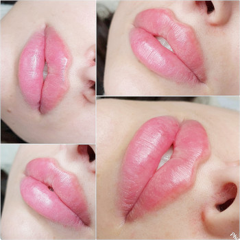 Контурная пластика лица
                    Косметолог-инъекционист Алина Днепр