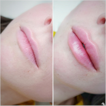 Контурная пластика лица
                    Косметолог-инъекционист Алина Днепр