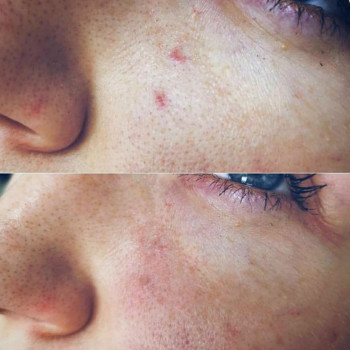 До и спустя 3 недели после удаления сосудистой сетки на лице