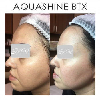 Биоревитализация Aquashine BTX
                    Косметолог Наталия Київ