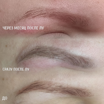 Удаление старого татуажа бровей