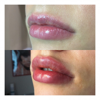 Увеличение губ. Препарат Neauvia Intense