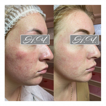 Карбокситерапия