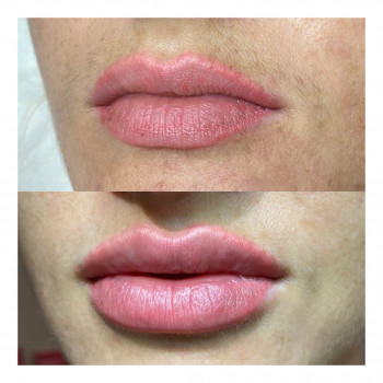 Увеличение губ препаратом Pluryal Volume
