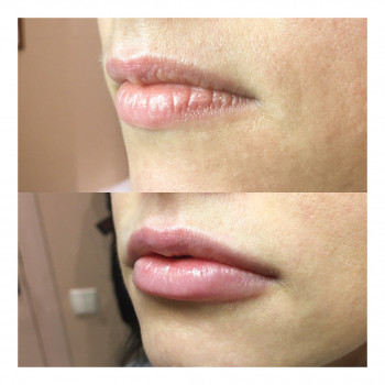 Увеличение губ препаратом Neauvia Lips