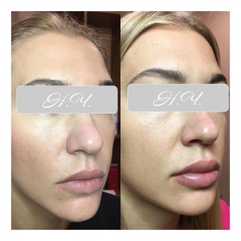 Увеличение губ