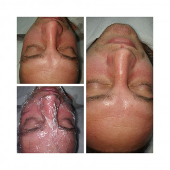 Комбинированная чистка