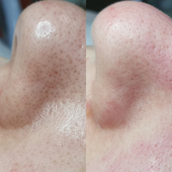 Механическая чистка