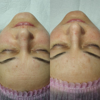 Комбинированная чистка