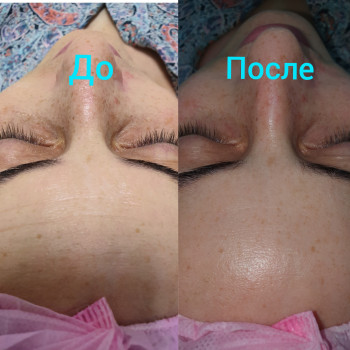 Карбокситерапия