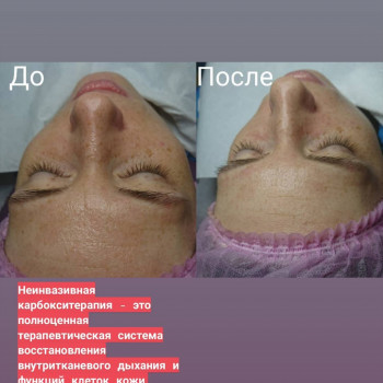 Карбокситерапия