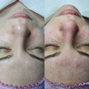 Комбинированная чистка