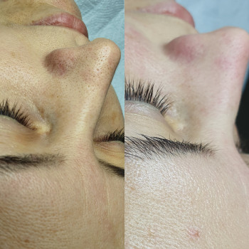 Механическая чистка