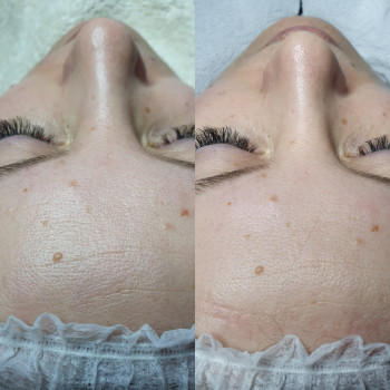 Карбокситерапия