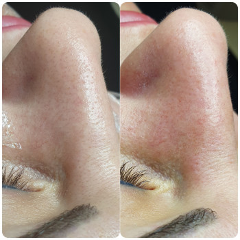 Механическая чистка