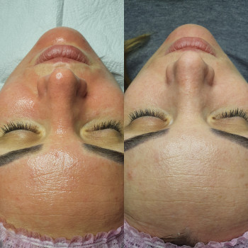 Атравматическая чистка