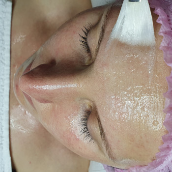 Карбокситерапия