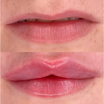 Аугментация губ