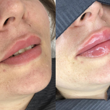 Контурная пластика губ , препарат Juvederm Ultra 3