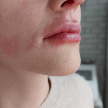 Аугментация губ