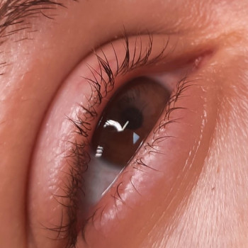 До процедуры