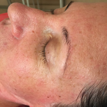 Лицо перед чисткой , уже умытое, кожа жирная , с высыпаниями