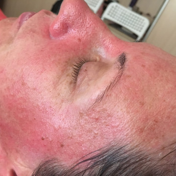 После чистки , покраснение есть , не травмирована