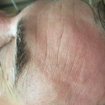 Лицо умытое, до массажа лица + фонофорез