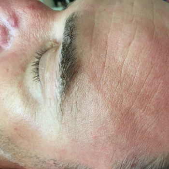 После массажа лица+ фонофорез