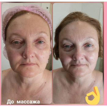 Результат одной процедуры массажа лица + лифтинговая маска