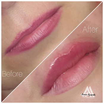 Увеличение губ
                    Косметолог Алена Харків