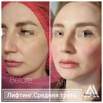 Контурная пластика скул
                    Косметолог Алена Харьков