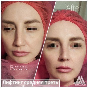 Контурная пластика скул
                    Косметолог Алена Харьков