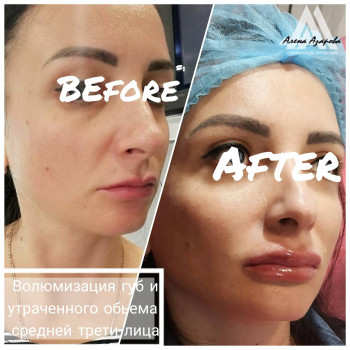 Контурная пластика скул
                    Косметолог Алена Харьков