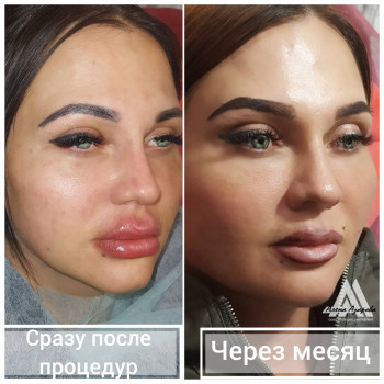 Контурная пластика скул
                    Косметолог Алена Харьков
