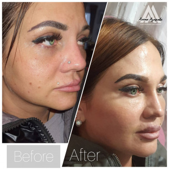 Контурная пластика скул
                    Косметолог Алена Харьков